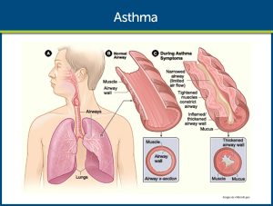 Asthma-Pathophysiology