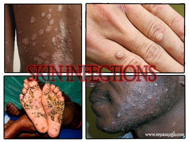skin infections