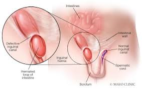 Hernia (Herbal Ways To Manage)